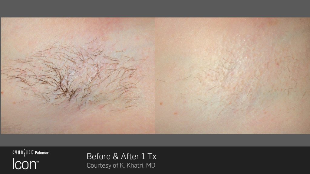Laser Hair Removal Before and After Photos 1 icon