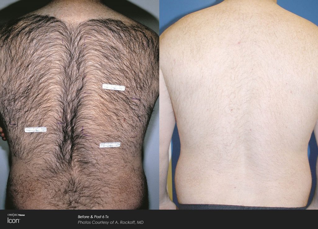 Laser Hair Removal Before and After Photos back icon