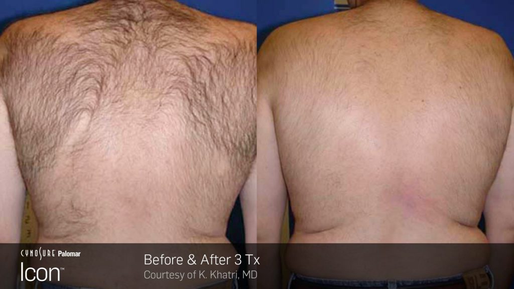 Laser Hair Removal Before and After Photos 3 icon