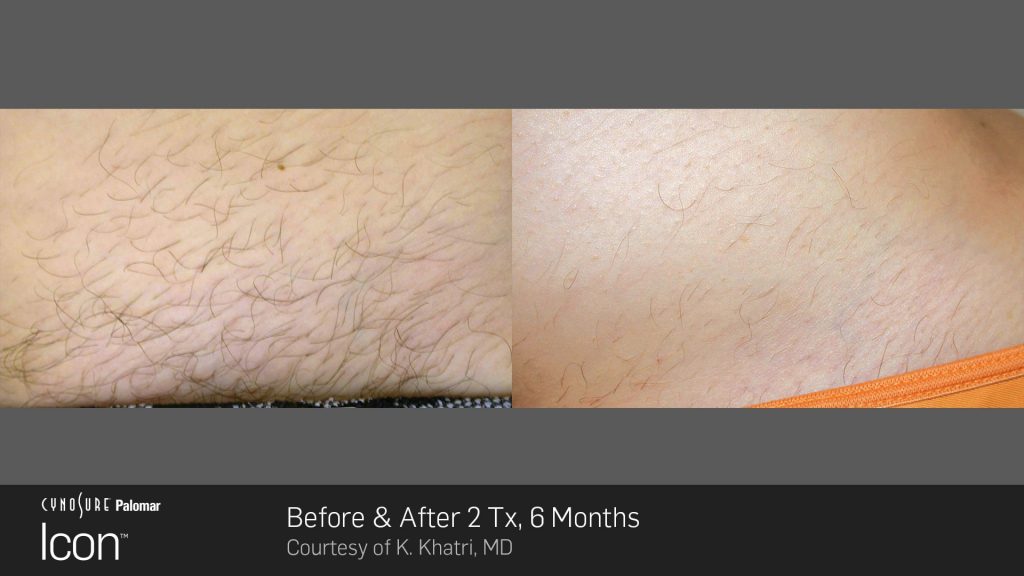 Laser Hair Removal Before and After Photos 5 icon stomach