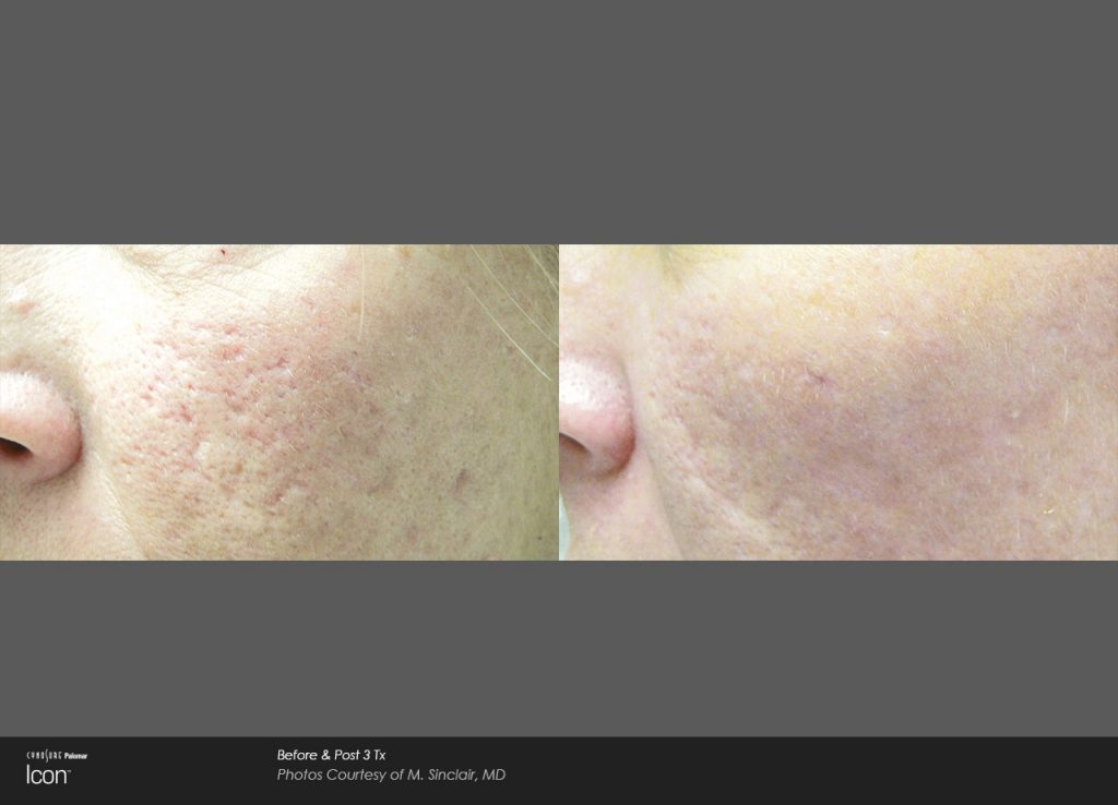 Laser Acne Scar Removal Before and After photos 5