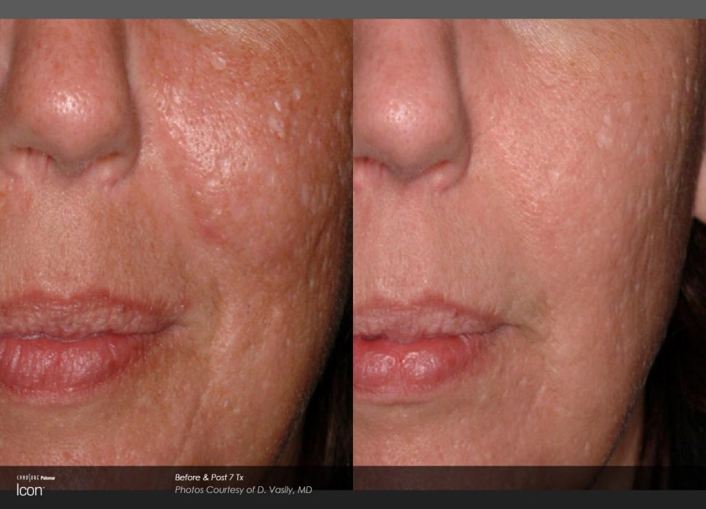 Laser Acne Scar Removal Before and After photos