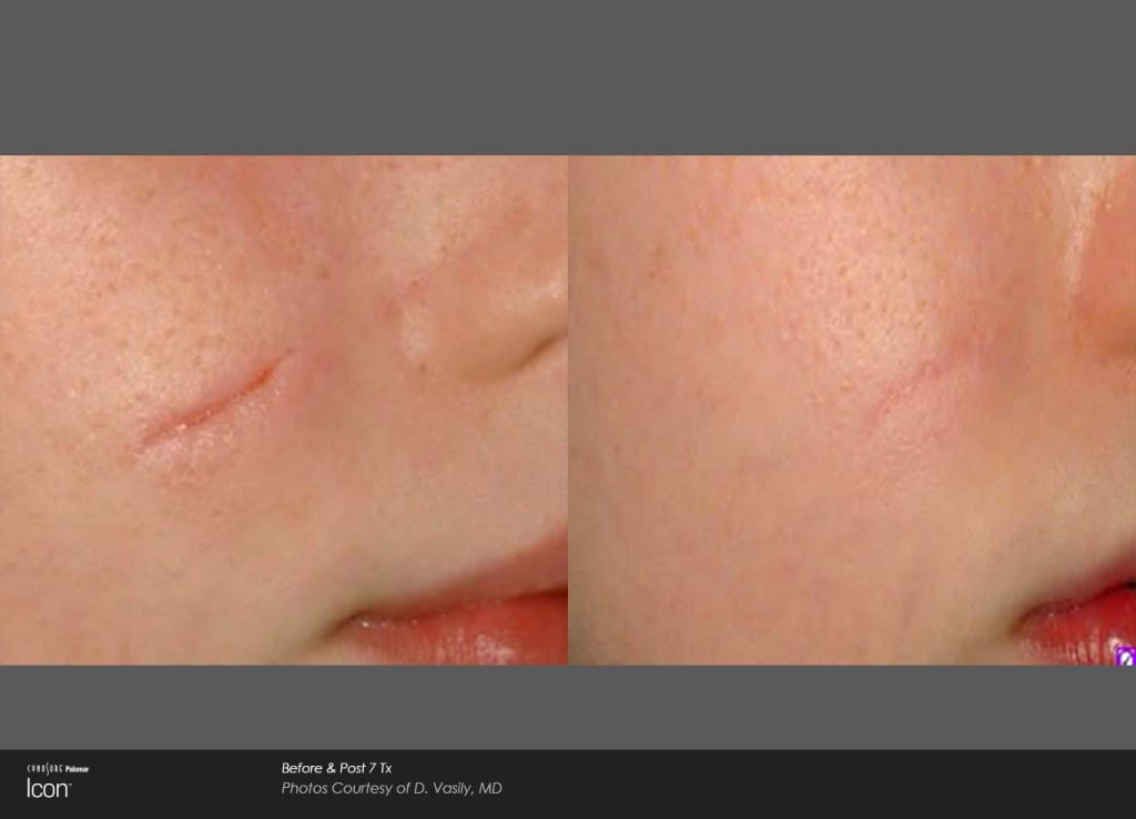 Laser Scar Removal Before and After photos 2