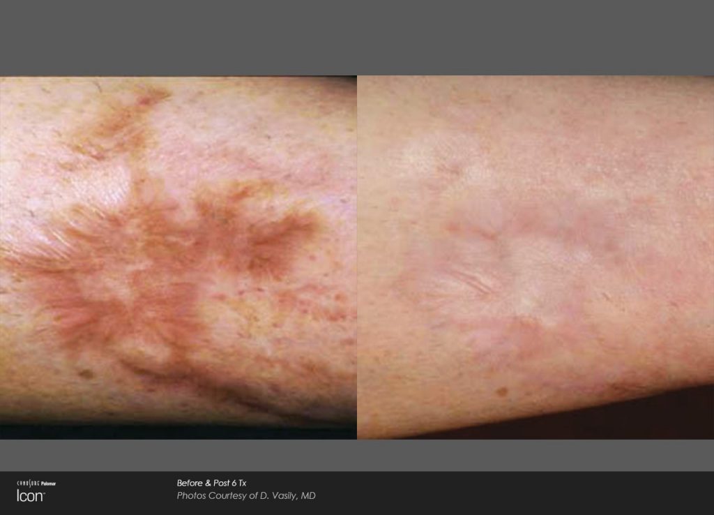 Laser Scar Removal Before and After photos 4
