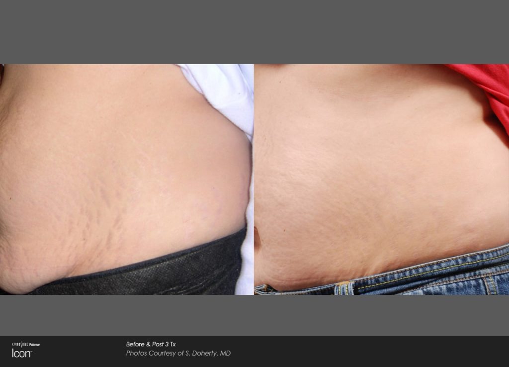 laser stretch mark removal before and after stomach