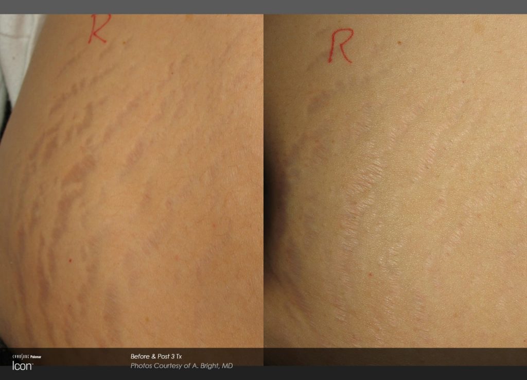 laser stretch mark removal before and after stomach 2