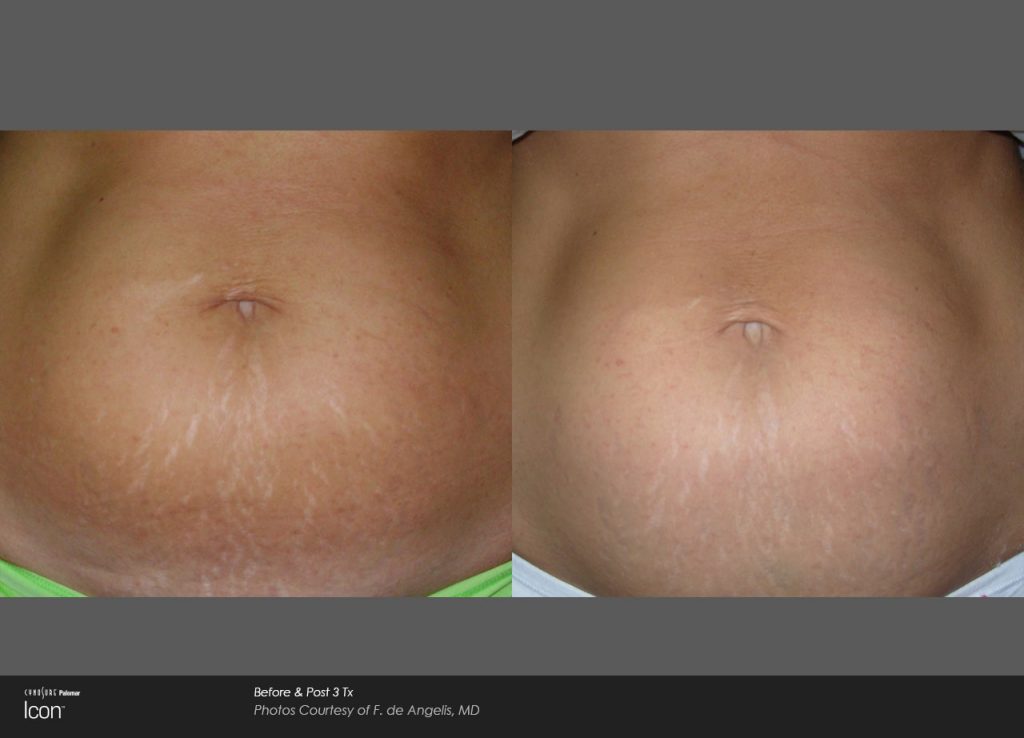 laser stretch mark removal before and after stomach 3