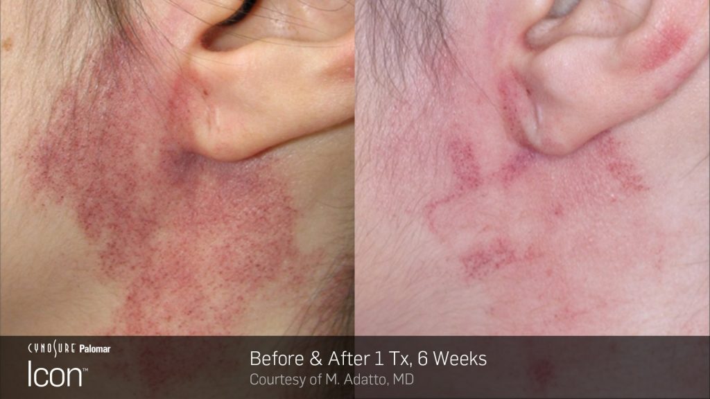 Laser Skin Revitalization Before and After photos : sun damage, uneven skin tone and rosacea