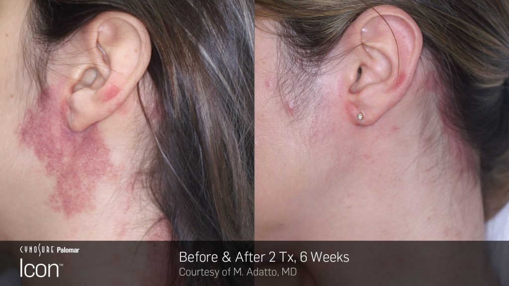 Laser Skin Revitalization Before and After photos : sun damage, uneven skin tone and rosacea  3