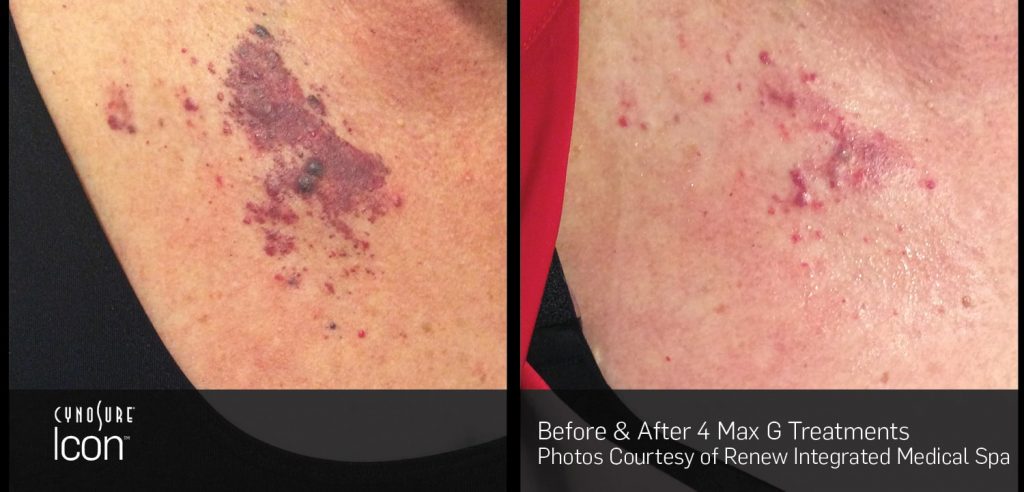 Laser Skin Revitalization Before and After photos : sun damage, uneven skin tone and rosacea, facial veins 1