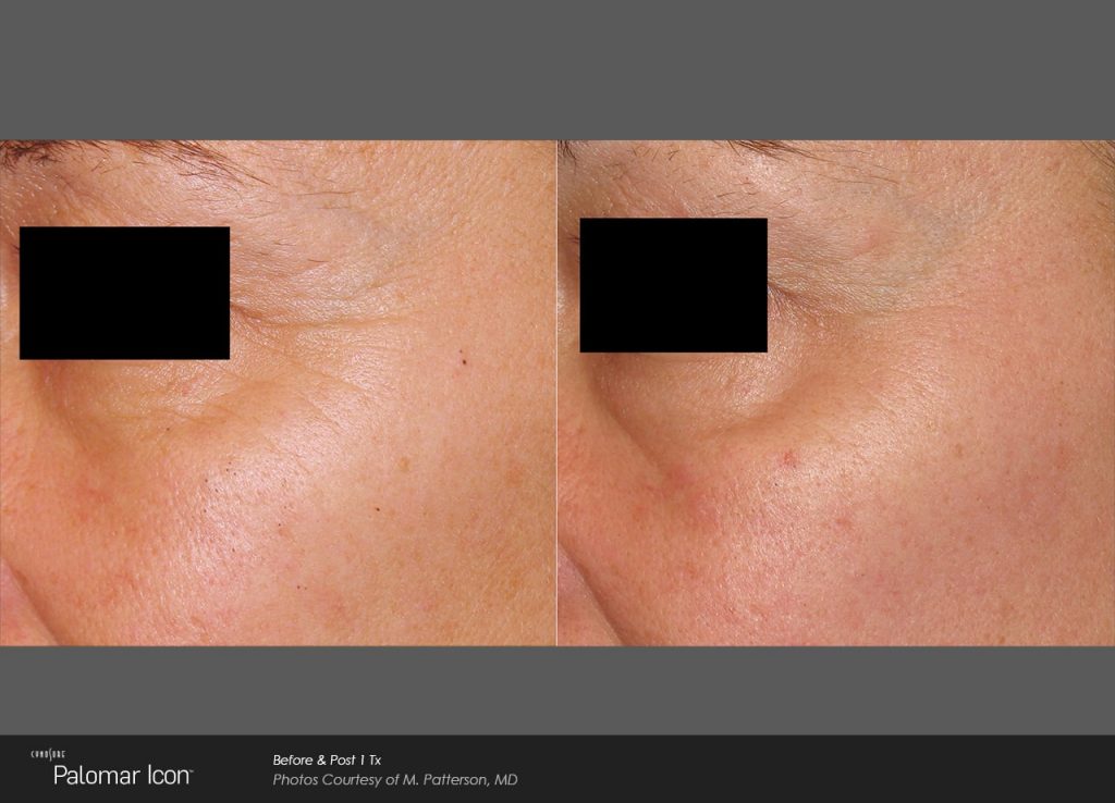 Laser Skin Renewal Before & After Photo-1-min