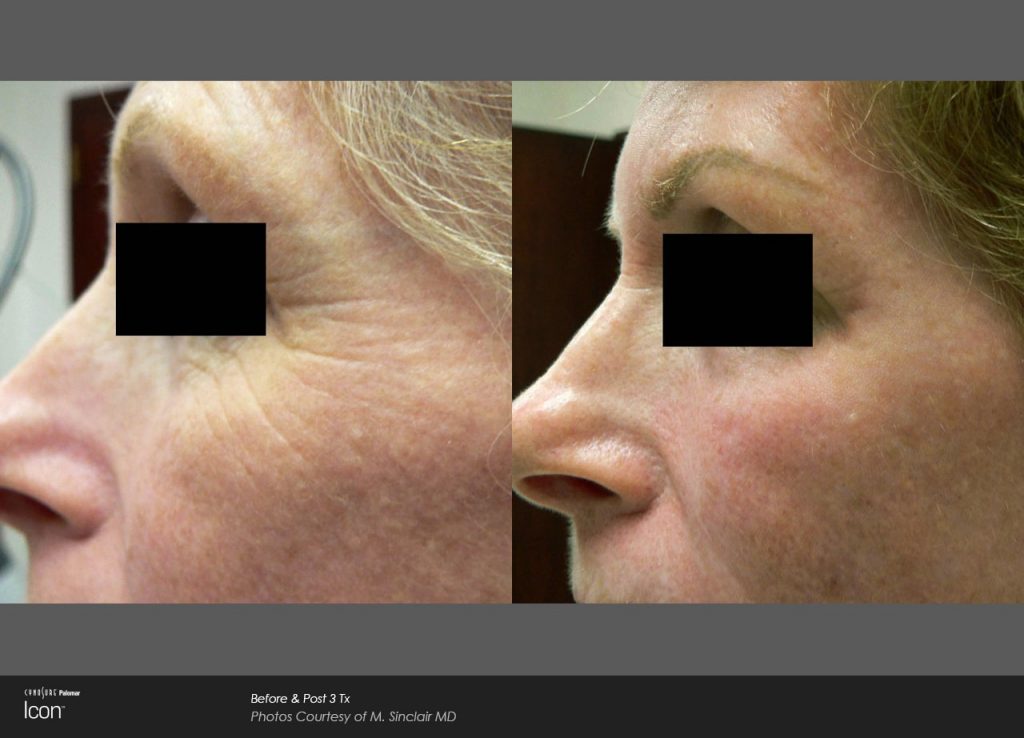 Laser Skin Renewal Before & After Photo