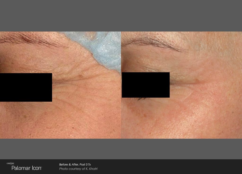 Laser Skin Renewal Before & After Photo-3-min