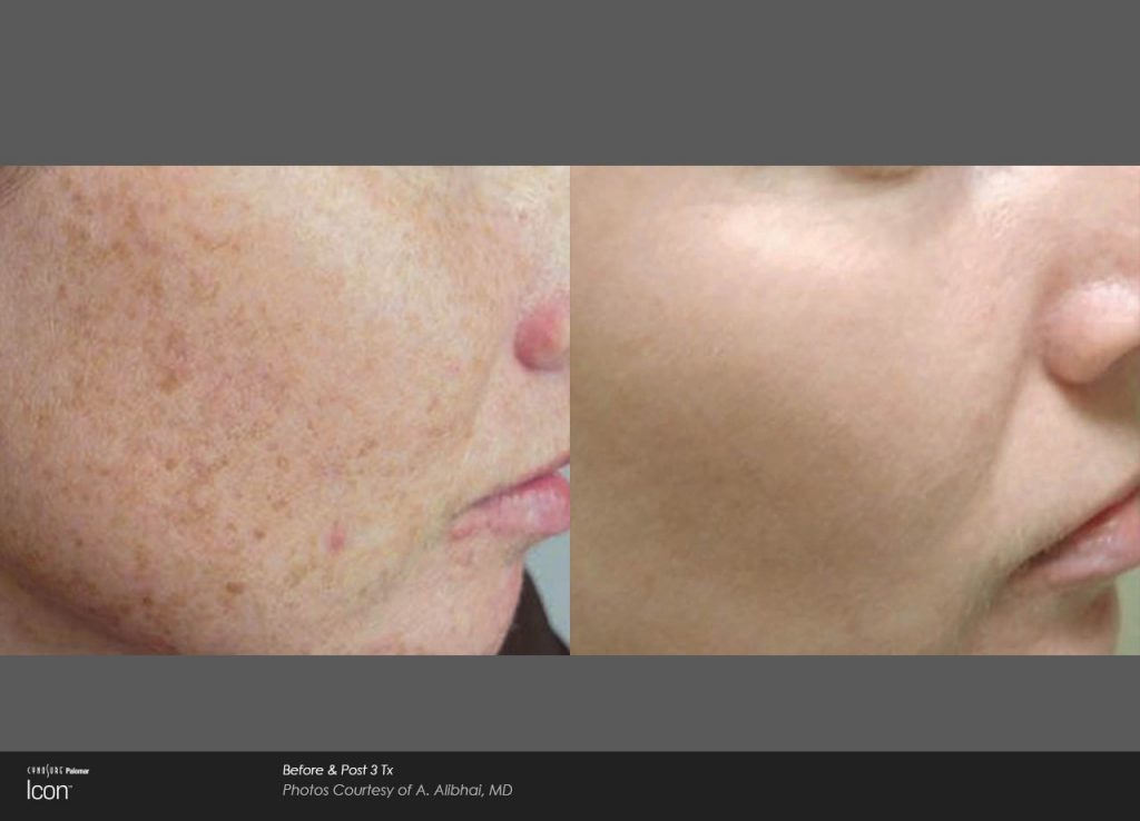Laser Skin Revitalization Before and After photos : sun damage, uneven skin tone and rosacea, facial veins 2