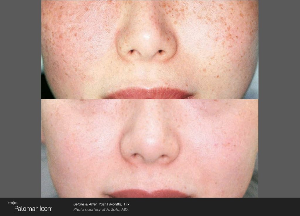 Laser Skin Revitalization Before and After photos freckles  4