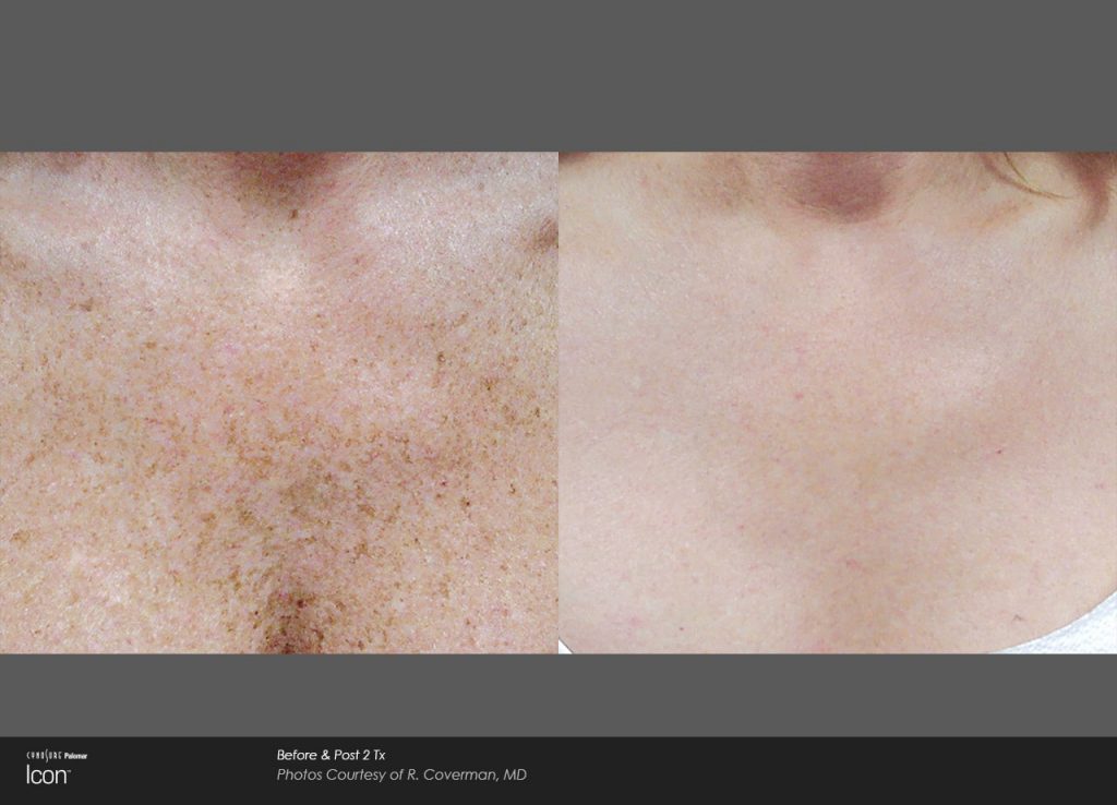 Laser Skin Revitalization Before and After photos : sun damage, uneven skin tone and rosacea, facial veins 3