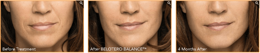 Fillers in Troy MI Before and After Belotero Balance