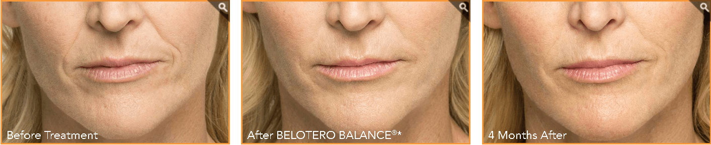 Fillers in Troy MI Before and After Belotero Balance 2