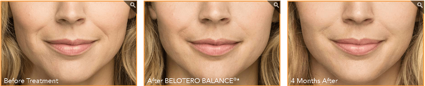 Fillers in Troy MI Before and After Belotero Balance 3