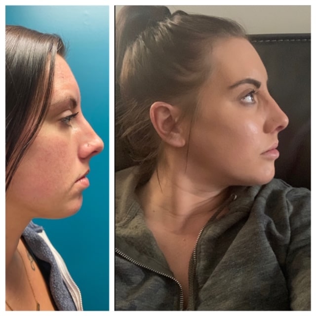 Dermal fillers Before and After Lip Fillers Before and After in Troy MI 6 by Sangita Patel M.D. at Iconic