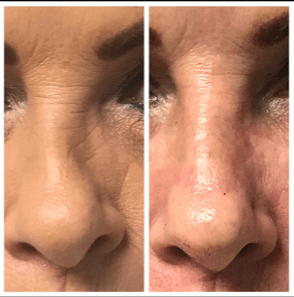 Dermal fillers Before and After Lip Fillers before and after Troy MI Dr Patel