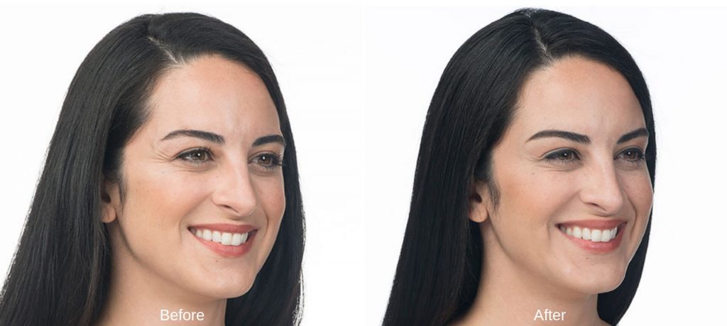 Botox before and after Troy MI 4