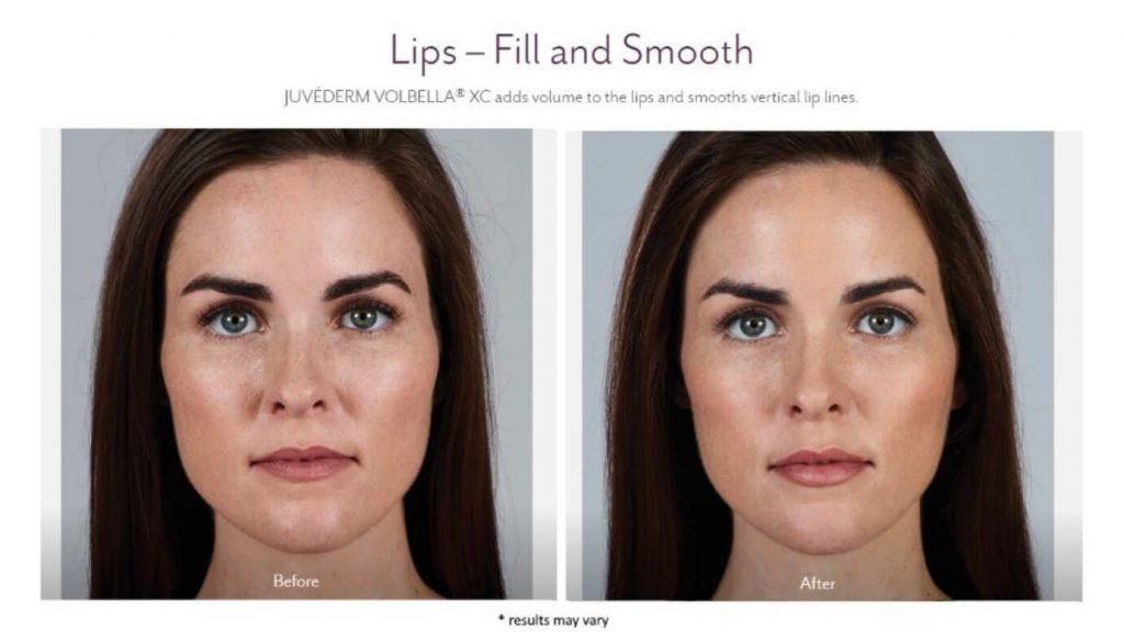 Fillers in Troy MI Before and After Juvederm Volbella XC 20