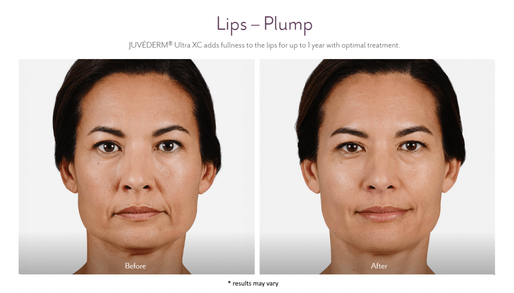 Fillers in Troy MI Before and After Juvederm Ultra XC 11