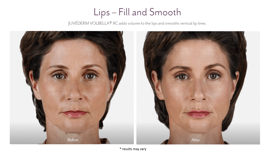 Fillers in Troy MI Before and After Juvederm Volbella XC 13