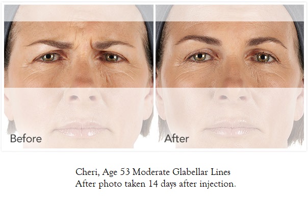 iconic-medical-skin-&-laser-center-xeomin-photos-cheri-604