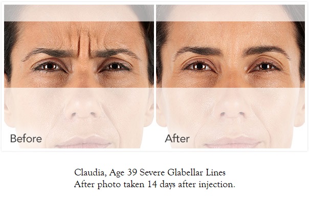iconic-medical-skin-&-laser-center-xeomin-photos-claudia-604