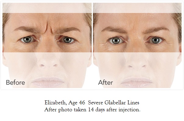 iconic-medical-skin-&-laser-center-xeomin-photos-elizabeth-604