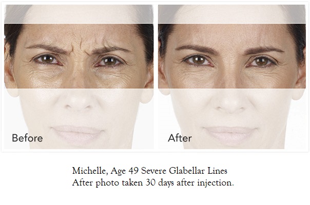 iconic-medical-skin-&-laser-center-xeomin-photos-michelle-604
