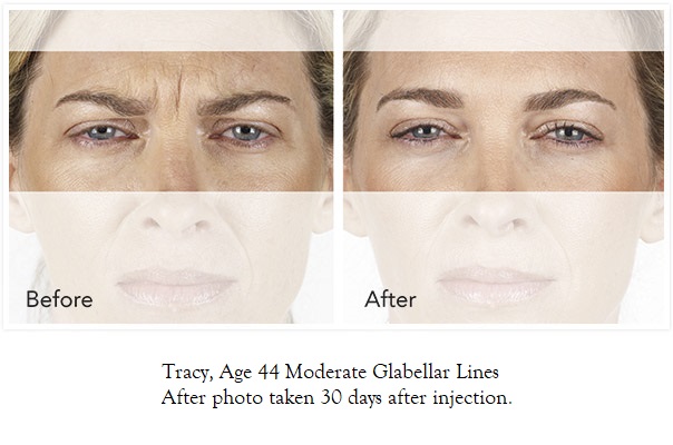 iconic-medical-skin-&-laser-center-xeomin-photos-tracy-604