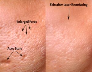 does laser stretch mark removal work on dark skin